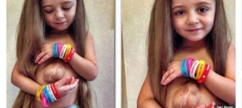 Niña vive con su corazón fuera del pecho Niña vive con su corazón fuera del pecho